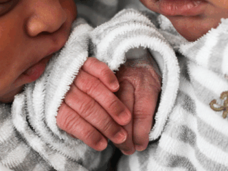 Siamese tweeling gescheiden