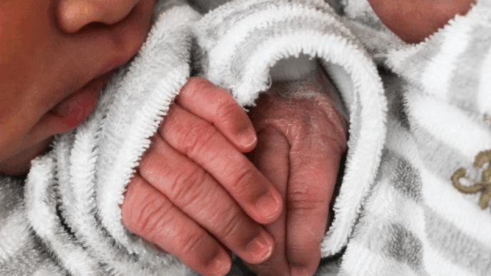 Siamese tweeling gescheiden