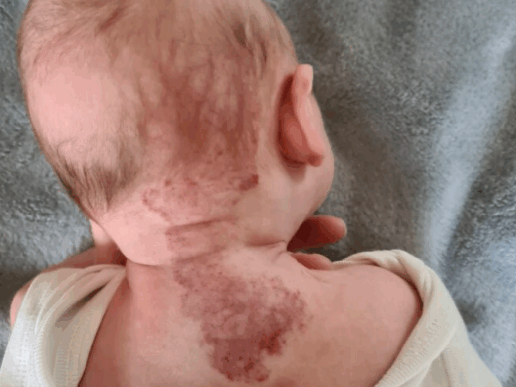 hemangioom baby symptomen baby vlek op rug