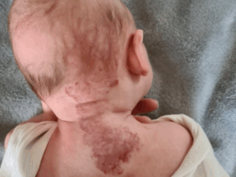 hemangioom baby symptomen baby vlek op rug