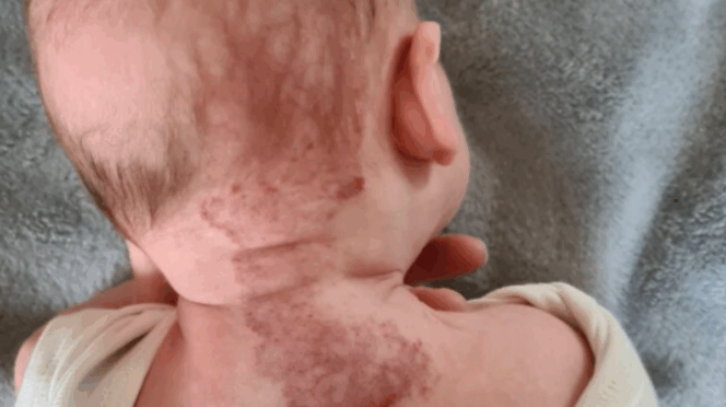 hemangioom baby symptomen baby vlek op rug