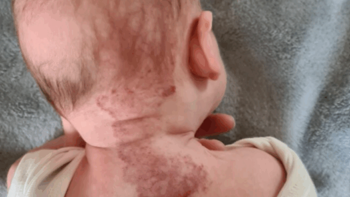hemangioom baby symptomen baby vlek op rug