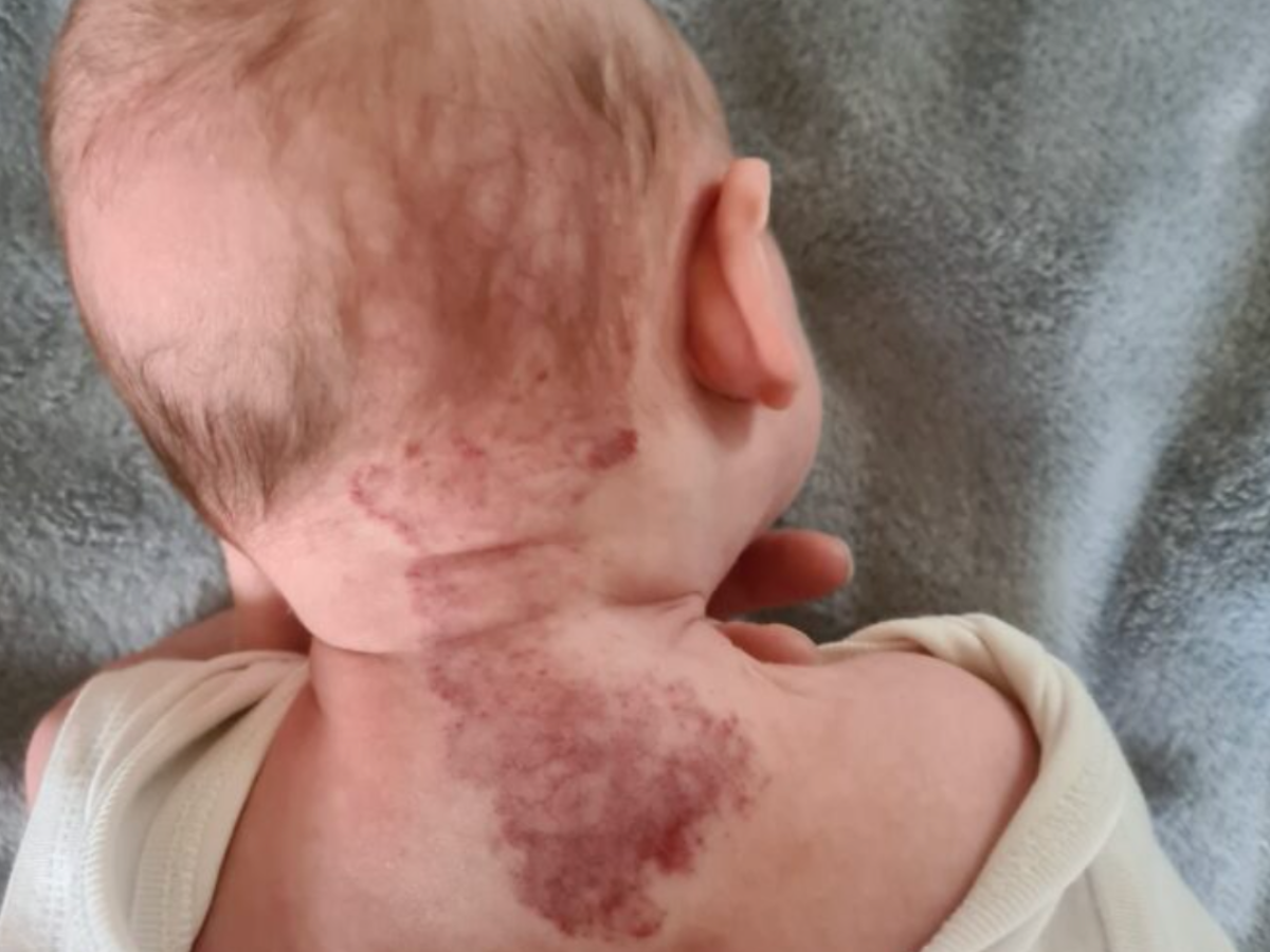 hemangioom baby symptomen baby vlek op rug