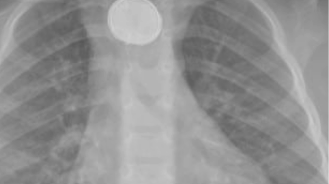 kind iets ingeslikt wat te doen rontgenfoto