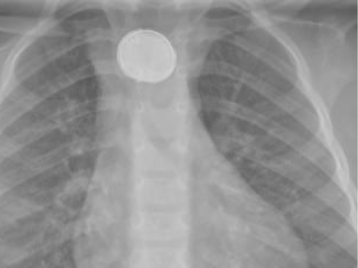 kind iets ingeslikt wat te doen rontgenfoto