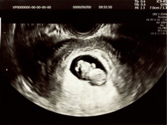 baby gapen in buik moeder foto van een echo